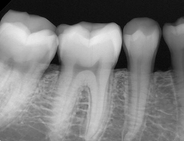X-ray of tooth inside gum